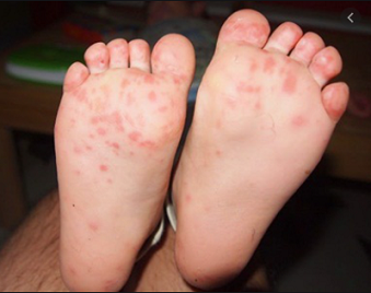 Dấu hiệu bệnh xuất hiện ở bàn chân