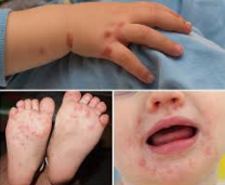 Cẩm nang tuyên truyền bệnh tay chân miệng ở trẻ em phòng chống hiệu quả